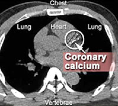 Coronary Calcium Scoring The Most Advanced Screening Method To Determine Risk Of Heart Disease With Coronary Ct Scan Starling Physicians